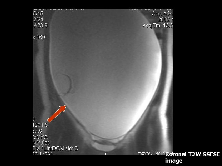 Coronal T 2 W SSFSE image 