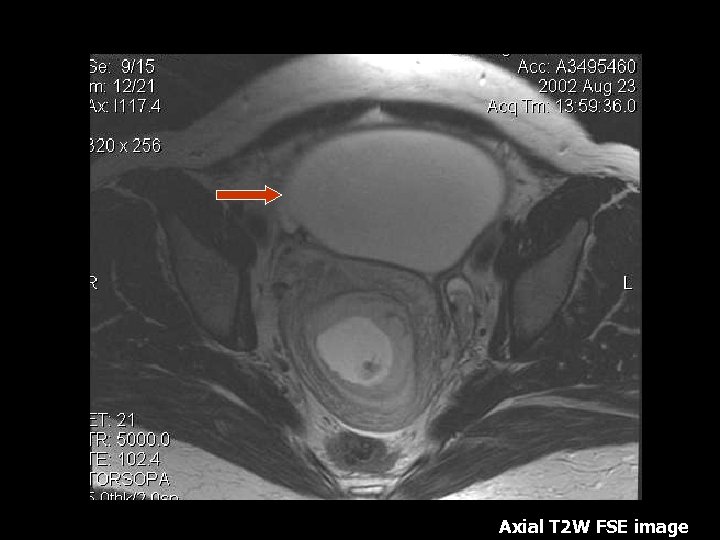 Axial T 2 W FSE image 