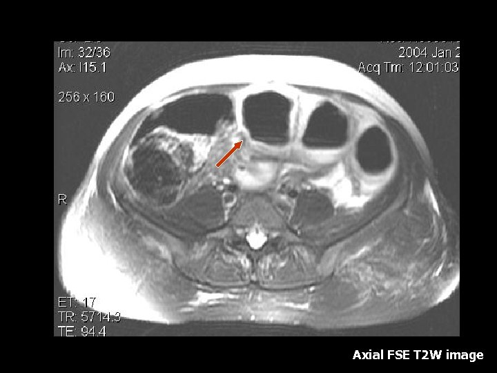 Axial FSE T 2 W image 