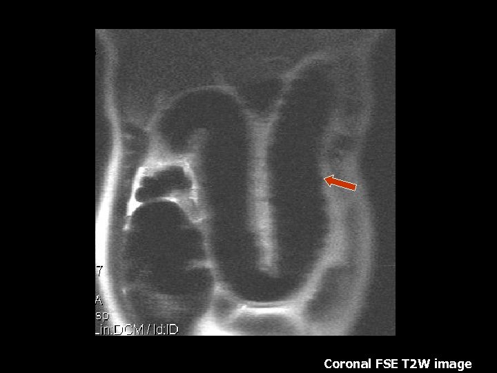 Coronal FSE T 2 W image 