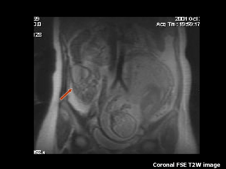 Coronal FSE T 2 W image 