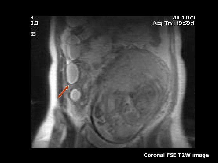 Coronal FSE T 2 W image 
