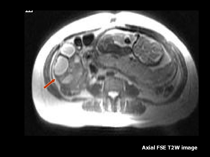 Axial FSE T 2 W image 