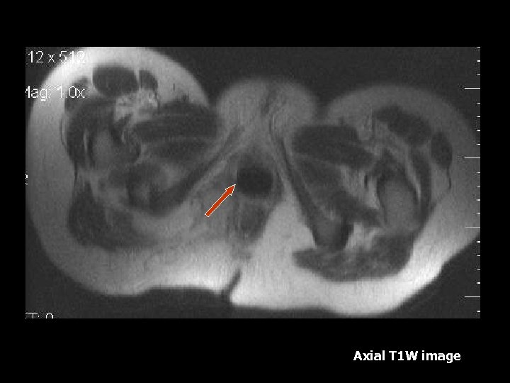 Axial T 1 W image 