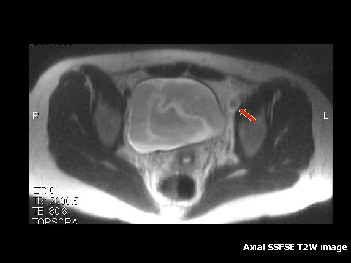 Axial SSFSE T 2 W image 