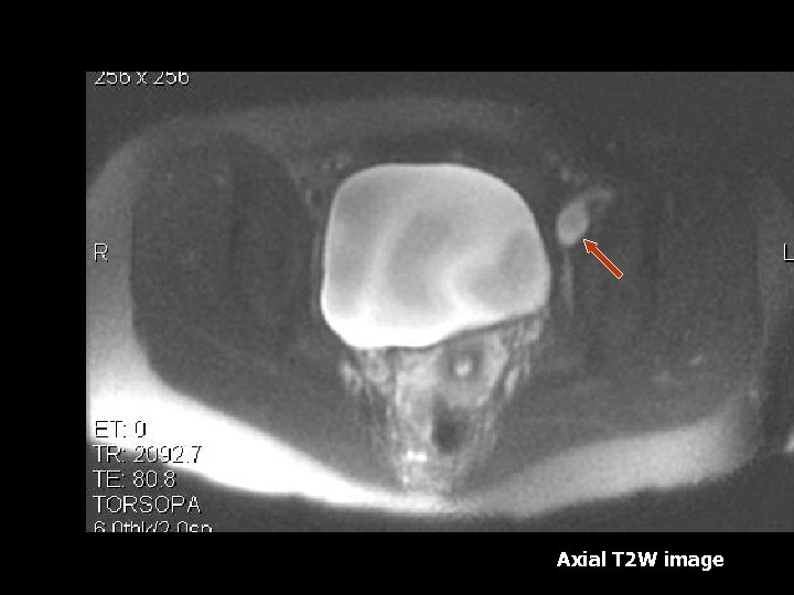 Axial T 2 W image 