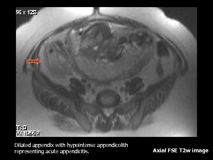 Dilated appendix with hypointense appendicolith representing acute appendicitis. Axial FSE T 2 w image