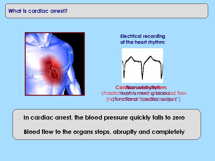 What is cardiac arrest? Electrical recording of the heart rhythm: Cardiac arrest rhythm: Normal