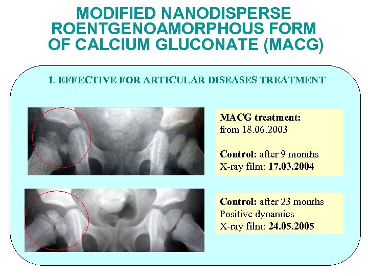 MODIFIED NANODISPERSE ROENTGENOAMORPHOUS FORM OF CALCIUM GLUCONATE (MACG) 1. EFFECTIVE FOR ARTICULAR DISEASES TREATMENT
