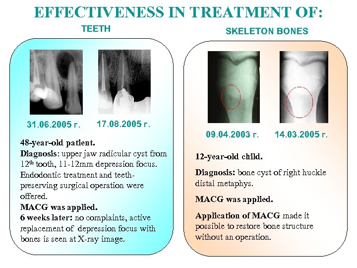 EFFECTIVENESS IN TREATMENT OF: TEETH 31. 06. 2005 г. SKELETON BONES 17. 08. 2005