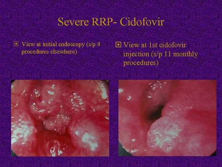 Severe RRP- Cidofovir View at initial endoscopy (s/p 4 procedures elsewhere) View at 1