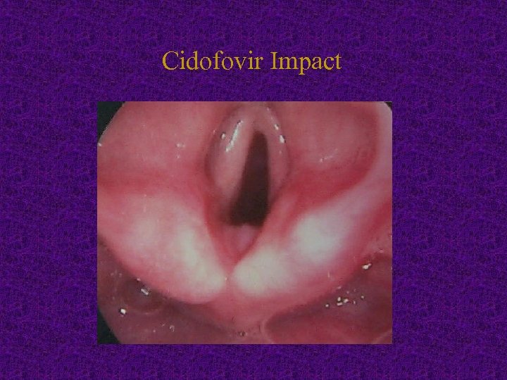 Cidofovir Impact 