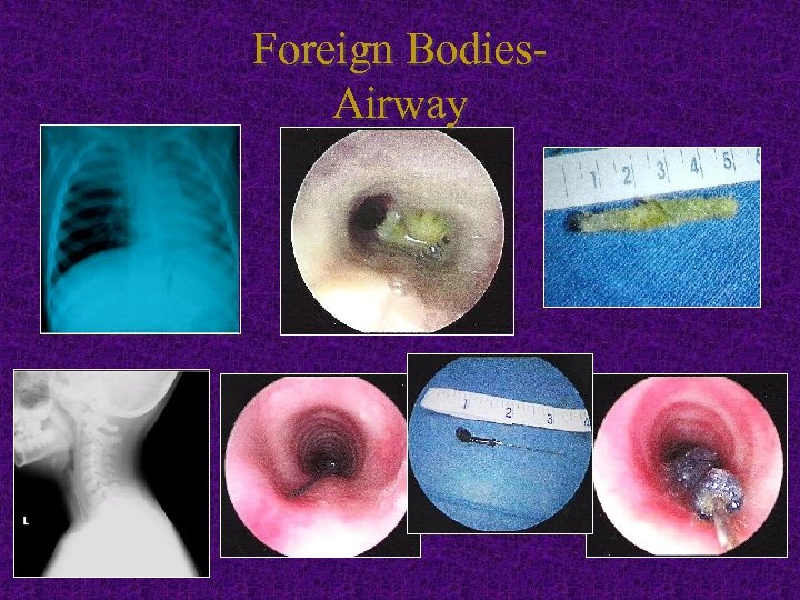 Foreign Bodies. Airway 