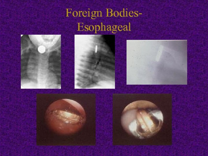Foreign Bodies. Esophageal 