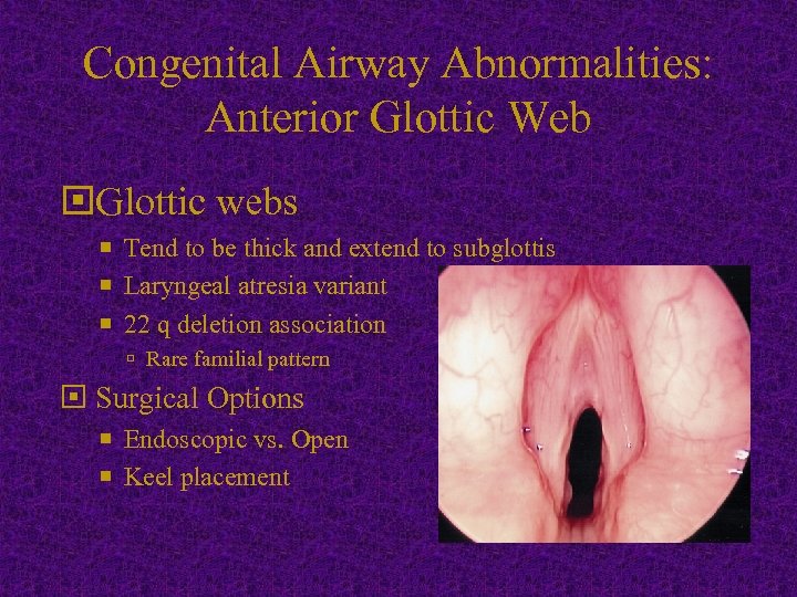 Congenital Airway Abnormalities: Anterior Glottic Web Glottic webs Tend to be thick and extend