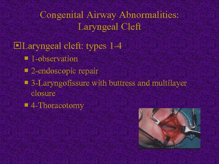 Congenital Airway Abnormalities: Laryngeal Cleft Laryngeal cleft: types 1 -4 1 -observation 2 -endoscopic