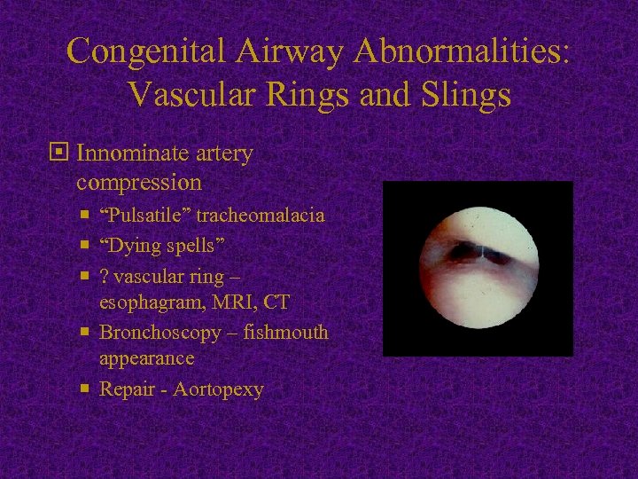 Congenital Airway Abnormalities: Vascular Rings and Slings Innominate artery compression “Pulsatile” tracheomalacia “Dying spells”