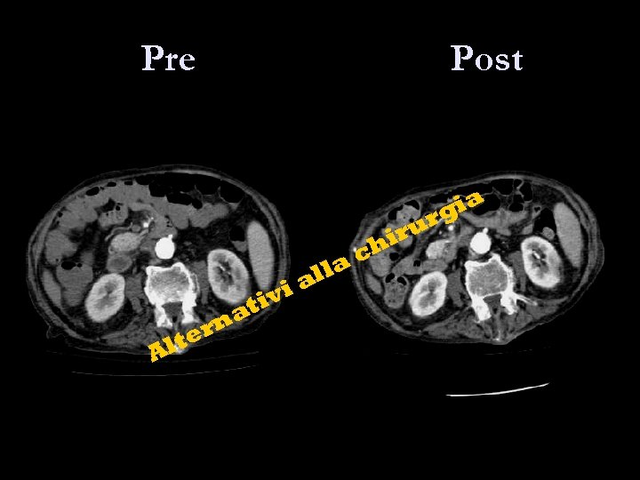 Pre Post ia g al vi ti t Al na er l ch a