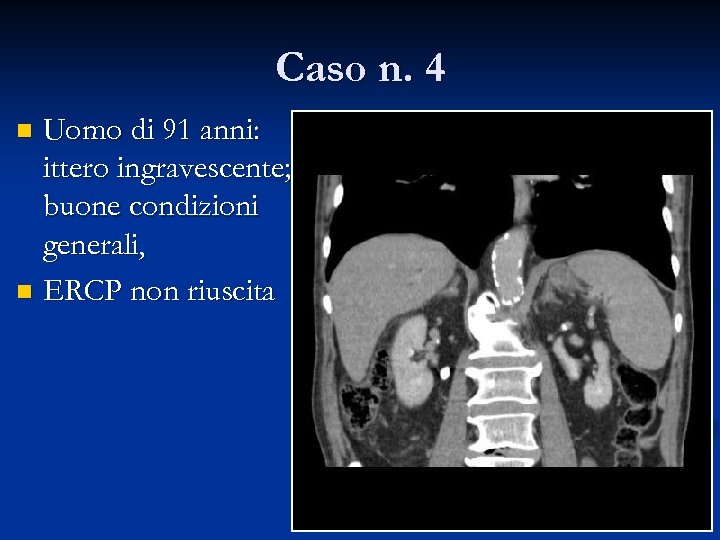 Caso n. 4 Uomo di 91 anni: ittero ingravescente; buone condizioni generali, n ERCP