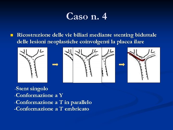 Caso n. 4 n Ricostruzione delle vie biliari mediante stenting biduttale delle lesioni neoplastiche