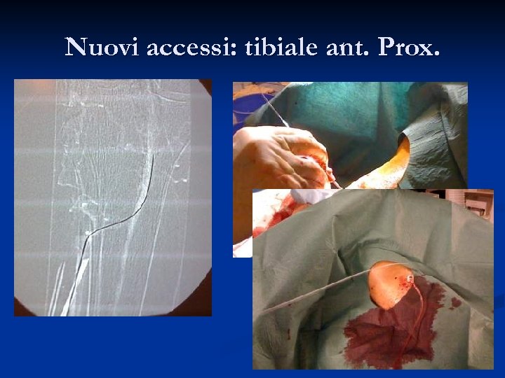 Nuovi accessi: tibiale ant. Prox. 