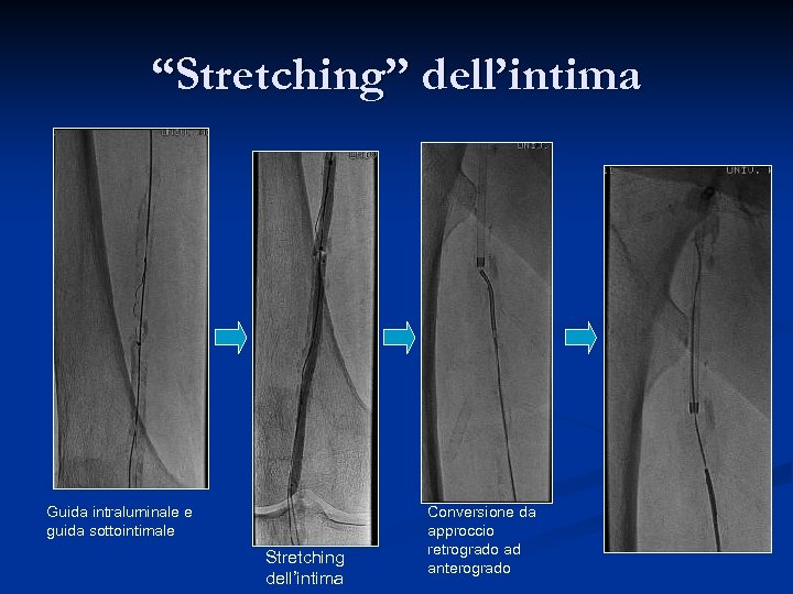 “Stretching” dell’intima Guida intraluminale e guida sottointimale Stretching dell’intima Conversione da approccio retrogrado ad