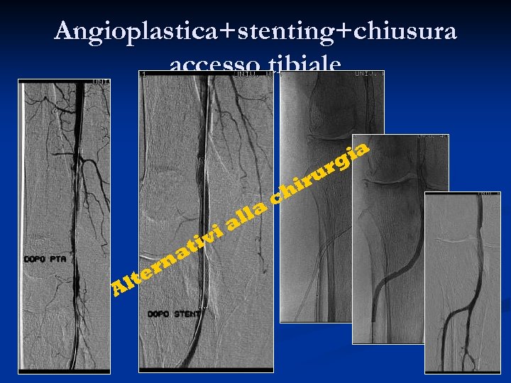Angioplastica+stenting+chiusura accesso tibiale ia g i tiv lte A na r lla a ch