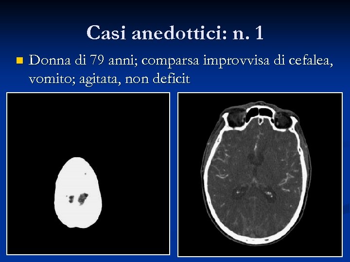 Casi anedottici: n. 1 n Donna di 79 anni; comparsa improvvisa di cefalea, vomito;