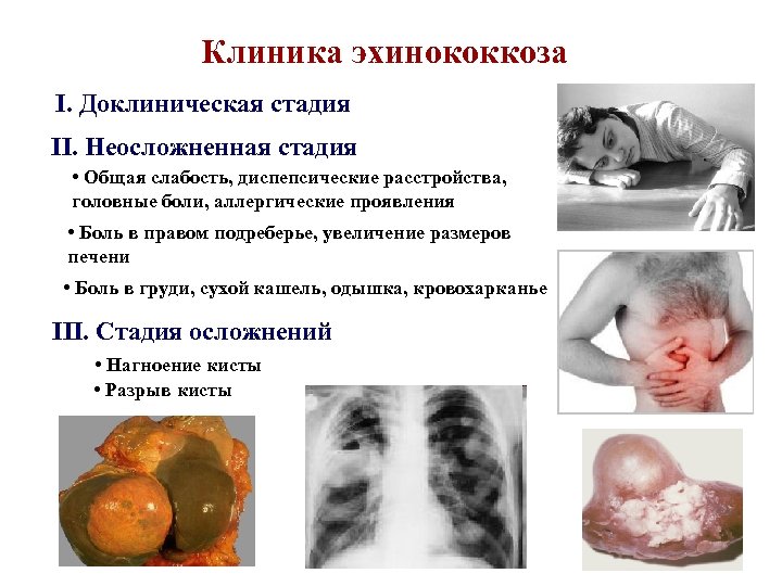 Клиника эхинококкоза I. Доклиническая стадия II. Неосложненная стадия • Общая слабость, диспепсические расстройства, головные