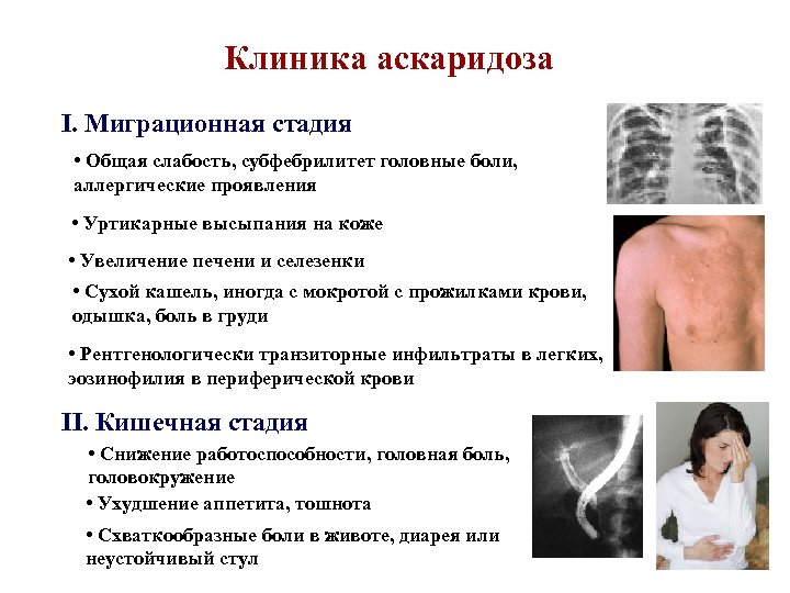 Клиника аскаридоза I. Миграционная стадия • Общая слабость, субфебрилитет головные боли, аллергические проявления •
