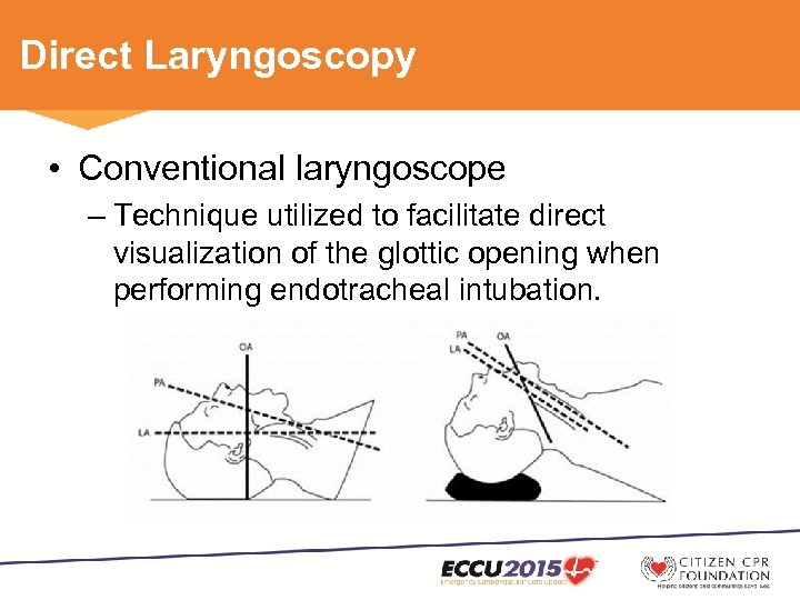 Direct Laryngoscopy • Conventional laryngoscope – Technique utilized to facilitate direct visualization of the