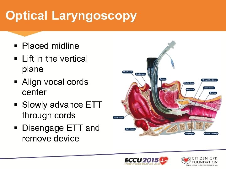 Video Laryngoscopy in Cardiac Arrest Colby J Rowe