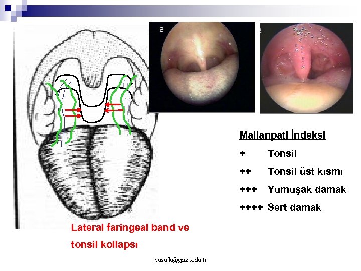 Mallanpati İndeksi + Tonsil ++ Tonsil üst kısmı +++ Yumuşak damak ++++ Sert damak
