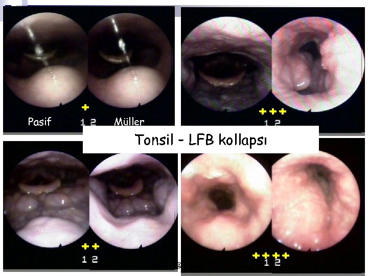 Pasif + +++ Müller Tonsil – LFB kollapsı ++ yusufk@gazi. edu. tr ++++ 