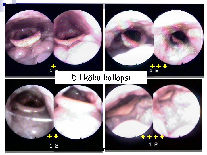 + Dil kökü kollapsı ++ ++++ yusufk@gazi. edu. tr 