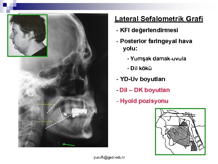 Lateral Sefalometrik Grafi - KFI değerlendirmesi - Posterior faringeyal hava yolu: - Yumşak damak-uvula