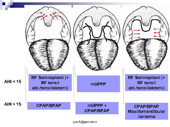 AHI < 15 AHI > 15 RF Somnoplasti (+ RF tonsil abl. /tonsillektomi) CPAP/BPAP