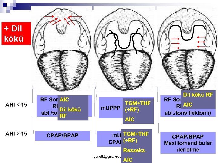 + Dil kökü AHI < 15 AHI > > 15 RF Somnoplasti (+ AİC