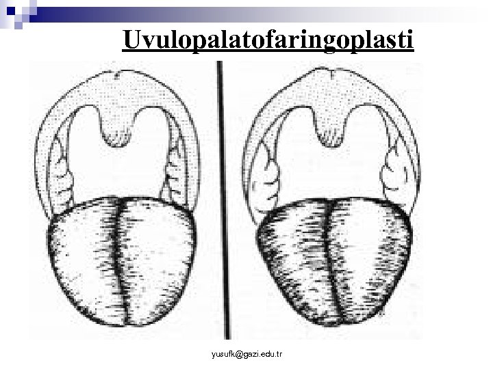 Uvulopalatofaringoplasti yusufk@gazi. edu. tr 