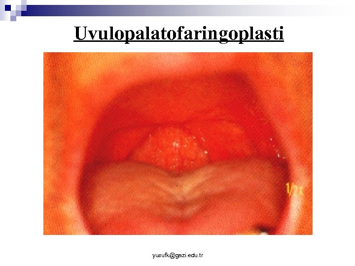 Uvulopalatofaringoplasti yusufk@gazi. edu. tr 