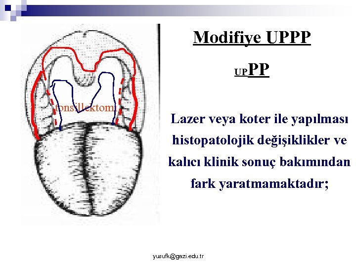 Modifiye UPPP UP tonsillektomi PP Lazer veya koter ile yapılması histopatolojik değişiklikler ve kalıcı