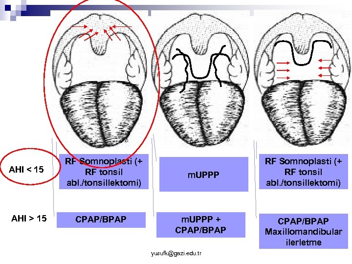 AHI < 15 AHI > 1515 AHI > RF Somnoplasti (+ RF tonsil abl.