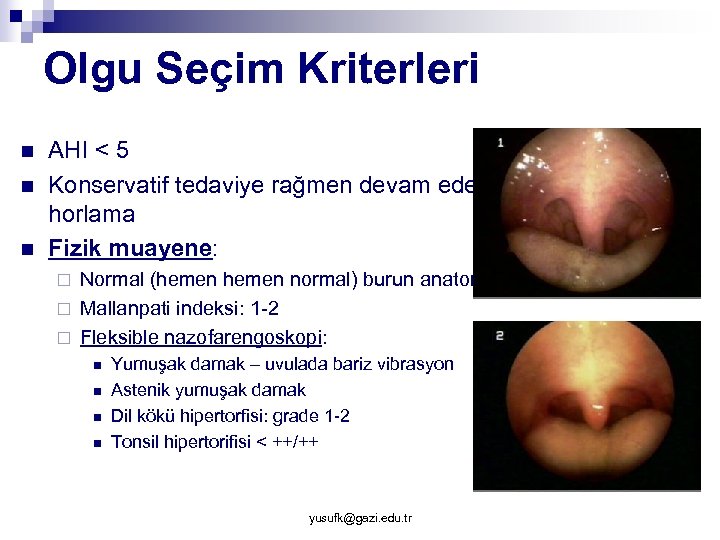 Olgu Seçim Kriterleri n n n AHI < 5 Konservatif tedaviye rağmen devam eden