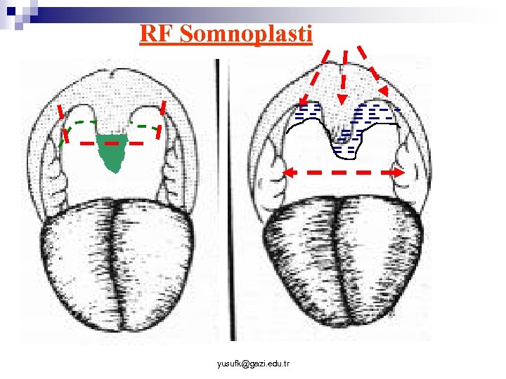 RF Somnoplasti yusufk@gazi. edu. tr 