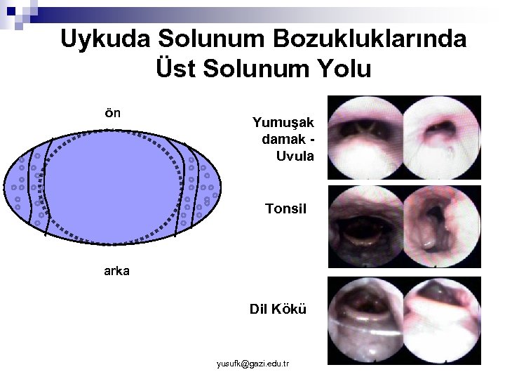 Uykuda Solunum Bozukluklarında Üst Solunum Yolu ön Yumuşak damak Uvula Tonsil arka Dil Kökü
