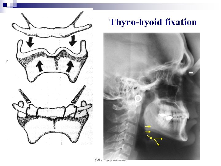 Thyro-hyoid fixation yusufk@gazi. edu. tr 