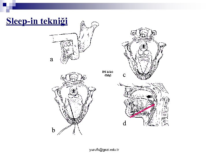 Sleep-in tekniği a Dil kökü dikişi c d b Dil kökünde sağlanan ilerleme yusufk@gazi.