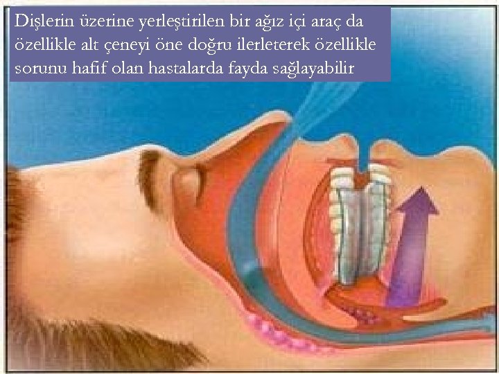 Dişlerin üzerine yerleştirilen bir ağız içi araç da özellikle alt çeneyi öne doğru ilerleterek