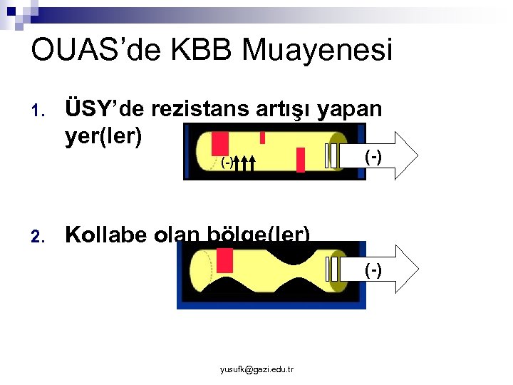 OUAS’de KBB Muayenesi 1. ÜSY’de rezistans artışı yapan yer(ler) (-) 2. (-) Kollabe olan