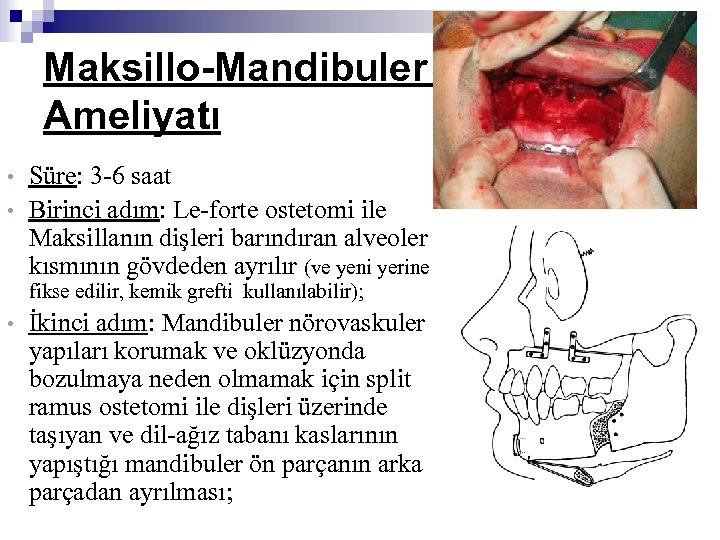 Maksillo-Mandibuler İlerletme Ameliyatı Süre: 3 -6 saat • Birinci adım: Le-forte ostetomi ile Maksillanın